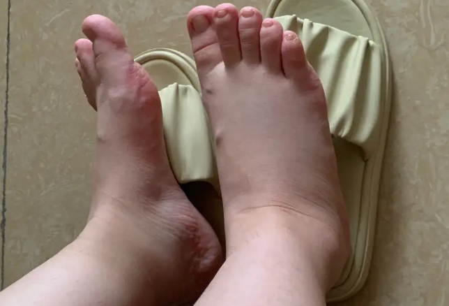 有孕晚期水肿医生会怎么做？