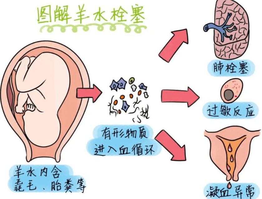 请问什么是羊水栓塞？