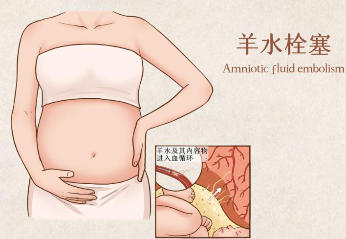 羊水栓塞的风险因素有哪些？