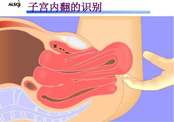 什么是子宫内翻？
