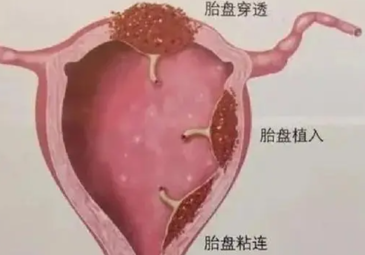 什么是胎盘植入？
