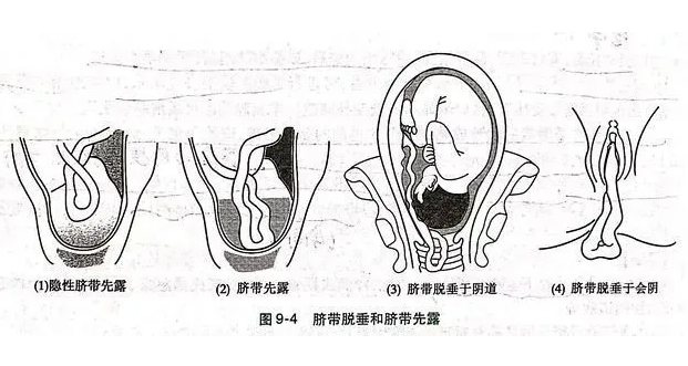 什么是显性脐带脱垂？