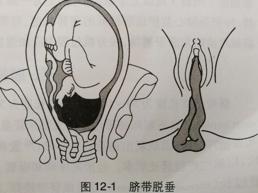 什么是隐性脐带脱垂？