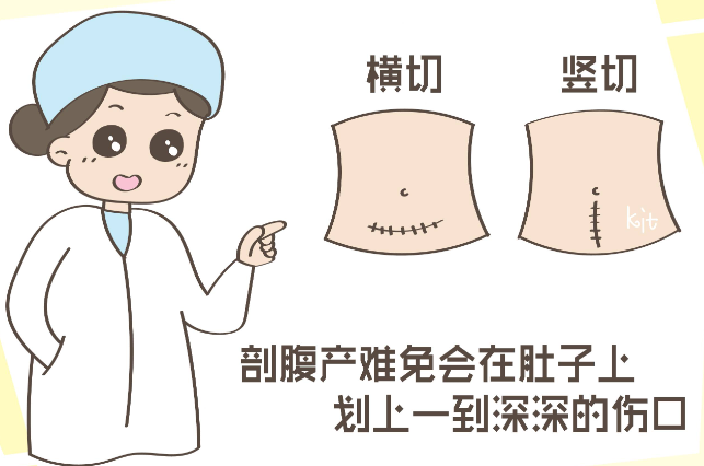 什么是剖腹产？