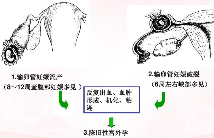请问什么是异位妊娠？