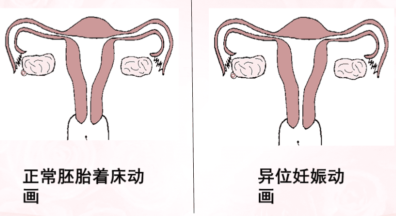 异位妊娠的症状有哪些？