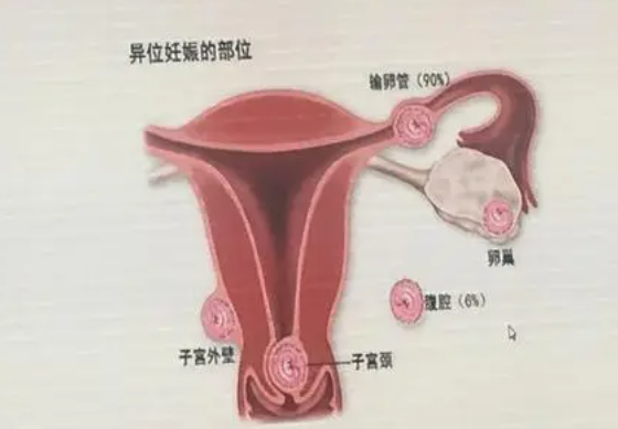 异位妊娠如何治疗？