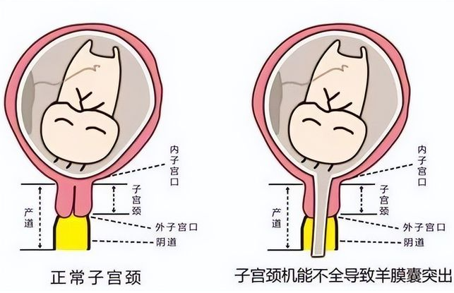 什么是宫颈机能不全？