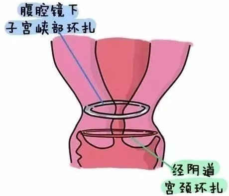 宫颈机能不全如何诊断？