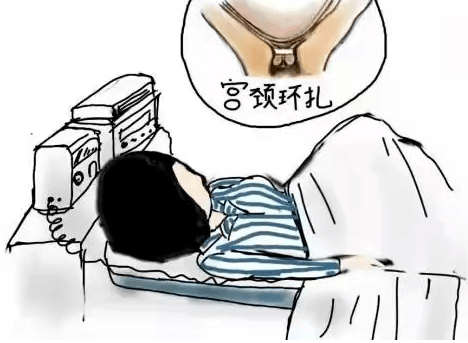 宫颈机能不全如何治疗？