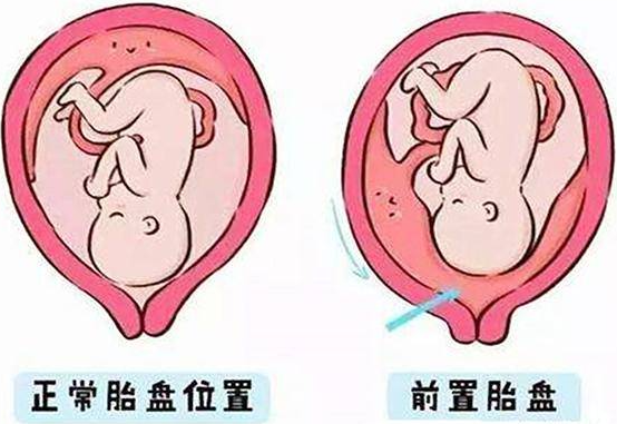 前置胎盘有什么症状？