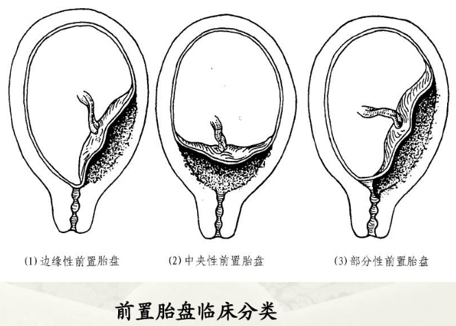 前置胎盘如何诊断？