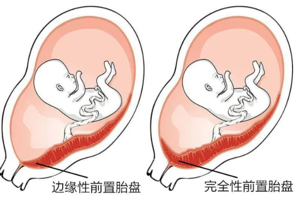 前置胎盘要如何治疗？