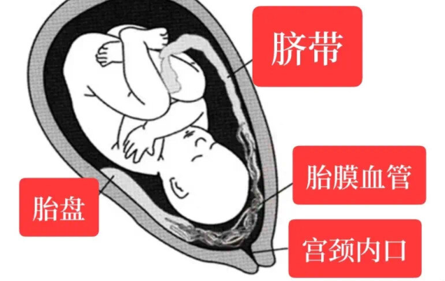 血管前置有什么症状？
