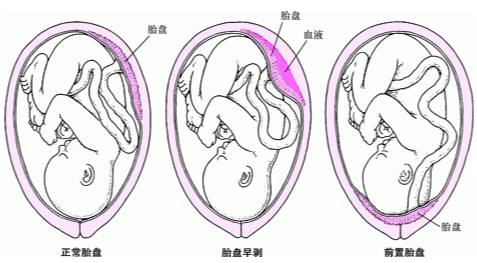 什么是胎盘早期剥离？
