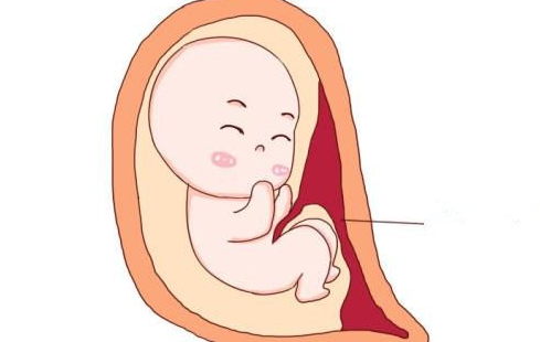 胎盘早剥如何诊断？