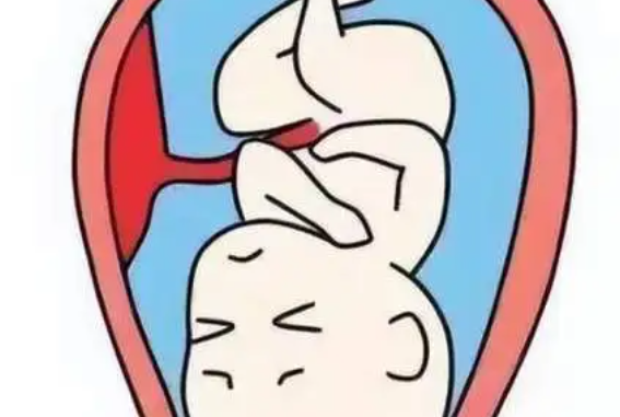 什么是羊膜腔感染？