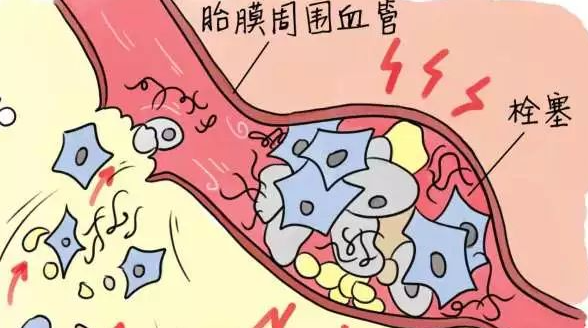 羊膜腔感染如何预防和治疗？