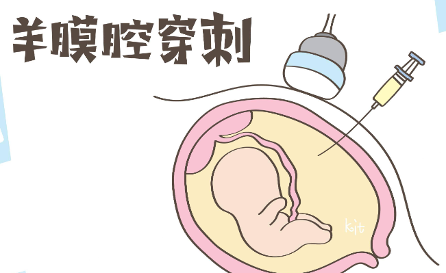 什么是羊膜腔穿刺术？