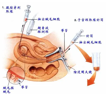 什么是绒毛膜绒毛取样？