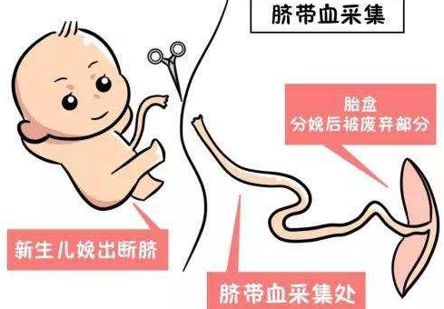 什么是经皮脐带血采样？
