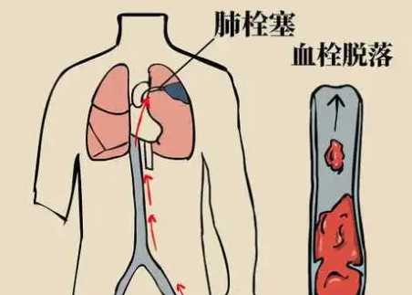 什么是产后血栓？