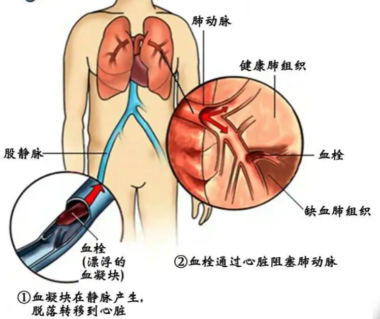 产后血栓如何诊断？