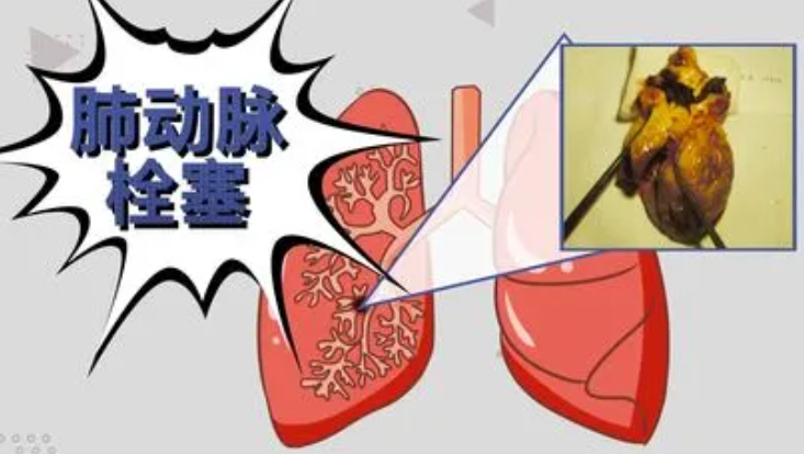 产后血栓如何治疗？