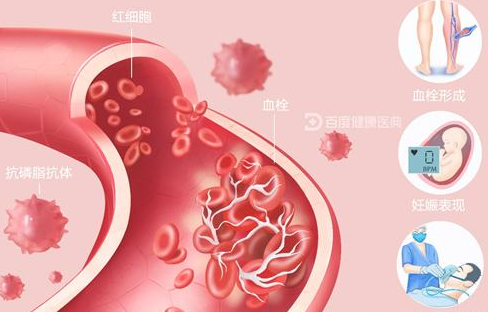 什么是抗磷脂综合征？