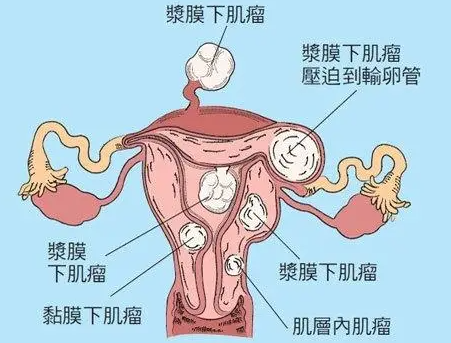 什么是妊娠期肌瘤？