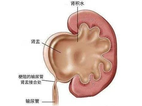 遇到孕期肾脏疾病怎么处理？