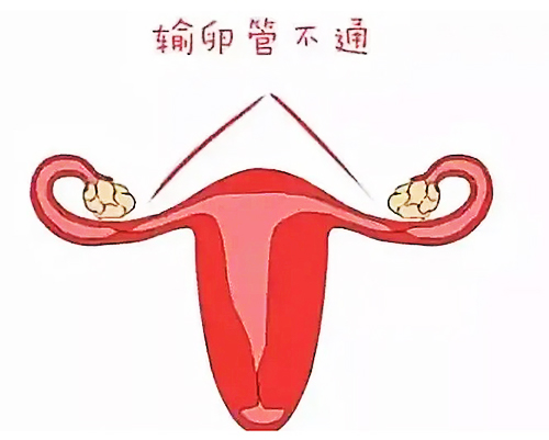 双侧输卵管堵塞=只能做试管？别着急！这里给你答案！