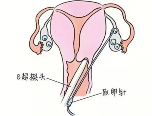 取卵手术是怎么做的，过程痛苦吗