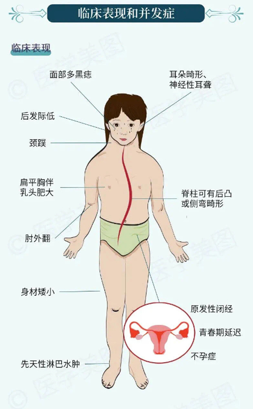 性染色体异常-特纳综合征