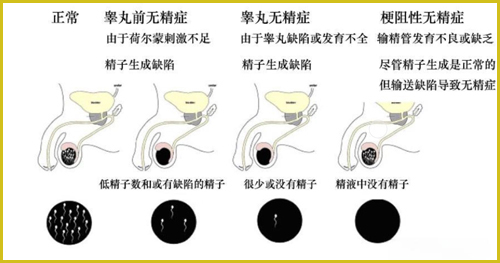 丈夫没有精子可以做试管婴儿吗？
