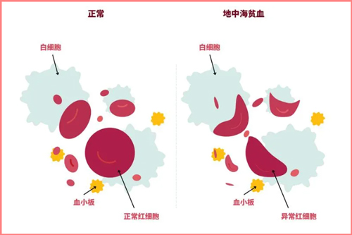遗传病科普-地中海贫血