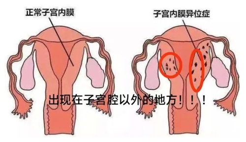 子宫内膜异位症做试管婴儿