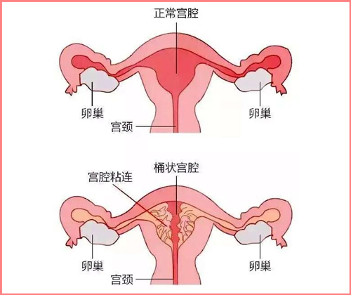 宫腔粘连会影响试管成功率吗？