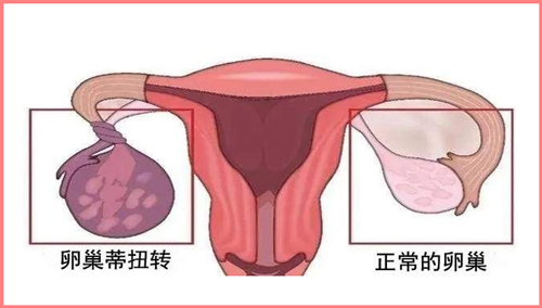 关于“卵巢扭转”，你应该知道的几个知识点