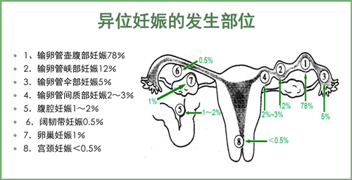 【健康科普】异位妊娠的病因及预防