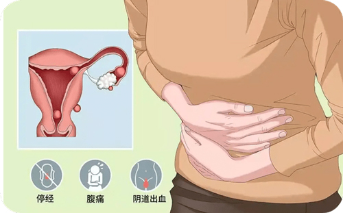 【健康科普】异位妊娠的病因及预防