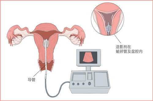 女性备孕必经之路—子宫输卵管造影