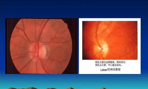 Leber遗传性视神经病变