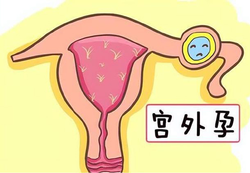 做试管移植，还会宫外孕吗？