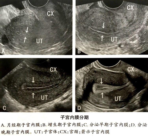 子宫内膜：决定孕育的成败