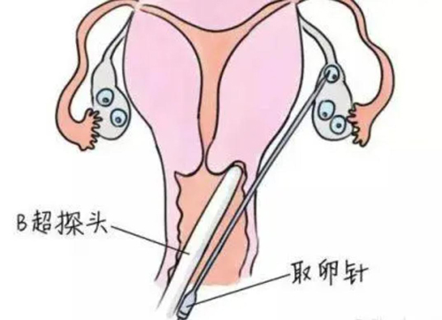 取卵后卵巢体积大要怎么恢复？