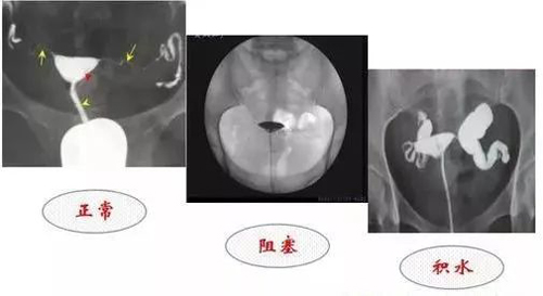输卵管积水可以直接做试管婴儿吗？