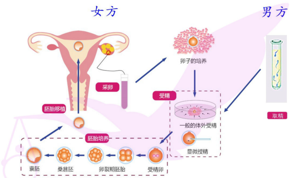 第一代试管婴儿体外授精-胚胎移植术
