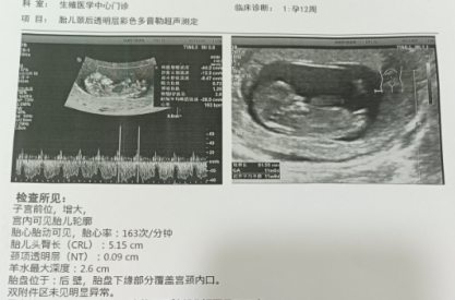 不孕4年+，43岁高龄妈妈试管助孕喜迎二胎宝宝！