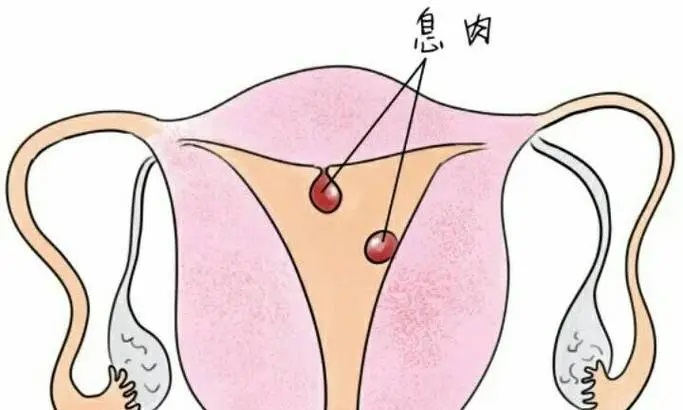 备孕发现子宫内膜息肉怎么办？